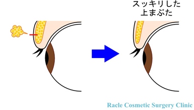 新宿ラクル美容外科クリニック　山本厚志　「エクセレントアイ（埋没法二重術）＋目の上の脂肪取り」
