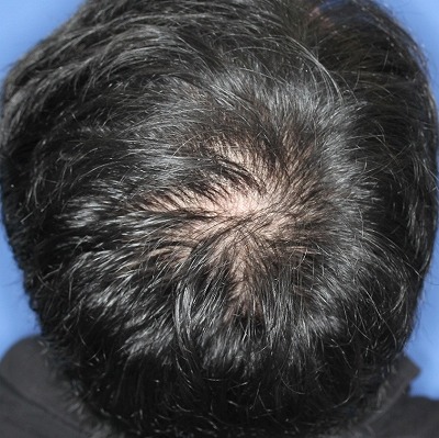ビフォーアフター 薄毛治療 Dr Cyj ヘアーフィラー 30代男性 4回目の手術後2週間目の変化です 新宿ラクル美容外科クリニック 山本厚志のブログ
