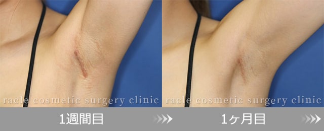 モティバ)エルゴノミクス(腋窩切開法)　傷の経過 1週間目、1ヶ月目写真