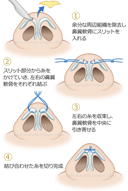 鼻尖縮小(鼻尖形成) ラクルの術式　イメージ