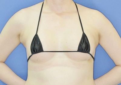 新宿ラクル美容外科クリニック　「Motiva（モティバ）エルゴノミクスによる豊胸術」　４０代女性　手術後１週間目