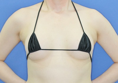 新宿ラクル美容外科クリニック　「Motiva（モティバ）エルゴノミクスによる豊胸術」　４０代女性　手術後３ヶ月目