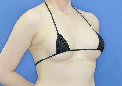 新宿ラクル美容外科クリニック　「Motiva（モティバ）エルゴノミクスによる豊胸術」　４０代女性　手術後３ヶ月目
