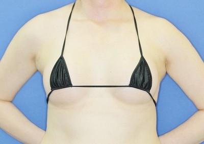 新宿ラクル美容外科クリニック　「Motiva（モティバ）エルゴノミクスによる豊胸術」　４０代女性　手術後１ヶ月目