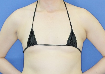 新宿ラクル美容外科クリニック　「Motiva（モティバ）エルゴノミクスによる豊胸術」　４０代女性　手術前
