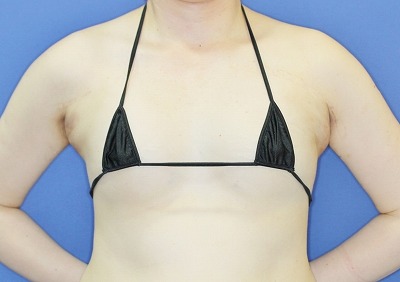 新宿ラクル美容外科クリニック　「Motiva（モティバ）エルゴノミクスによる豊胸術」　４０代女性　手術直後