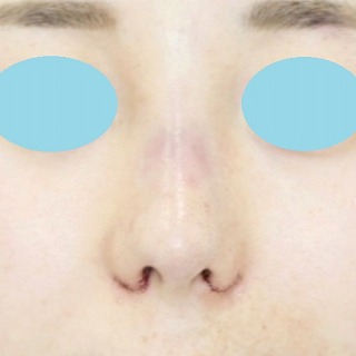 「鼻プロテーゼ＋鼻尖縮小（close法）＋耳介軟骨移植＋小鼻縮小」　新宿ラクル美容外科クリニック　２０代女性　手術直後