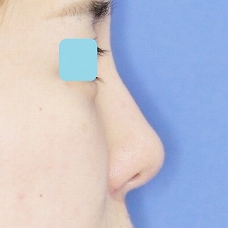 「鼻プロテーゼ＋鼻尖縮小（close法）＋耳介軟骨移植＋小鼻縮小」　新宿ラクル美容外科クリニック　２０代女性　手術後２ヶ月目