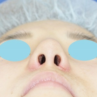 「鼻プロテーゼ＋鼻尖縮小（close法）＋耳介軟骨移植＋小鼻縮小」　新宿ラクル美容外科クリニック　２０代女性　手術後１週間目
