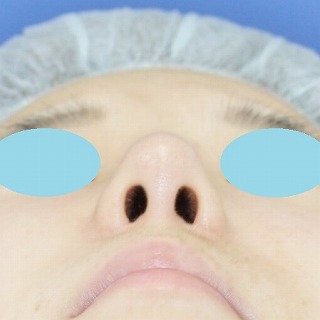 「鼻プロテーゼ＋鼻尖縮小（close法）＋耳介軟骨移植＋小鼻縮小」　新宿ラクル美容外科クリニック　２０代女性　手術後３ヶ月目