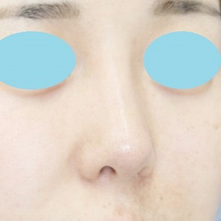 「鼻プロテーゼ＋鼻尖縮小（close法）＋耳介軟骨移植＋小鼻縮小」　新宿ラクル美容外科クリニック　２０代女性　手術後３ヶ月目