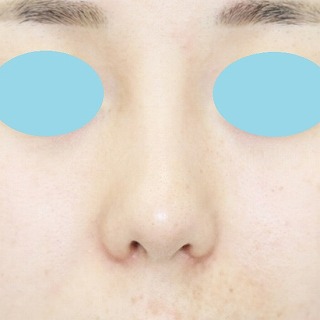 「鼻プロテーゼ＋鼻尖縮小（close法）＋耳介軟骨移植＋小鼻縮小」　新宿ラクル美容外科クリニック　２０代女性　手術後１ヶ月目
