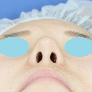 「鼻プロテーゼ＋鼻尖縮小（close法）＋耳介軟骨移植＋小鼻縮小」　新宿ラクル美容外科クリニック　２０代女性　手術後１ヶ月目