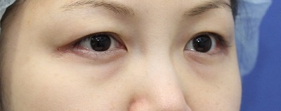 新宿ラクル美容外科クリニック　山本厚志　「切らない目の下のたるみ取り」　リデンシティⅡ　手術前