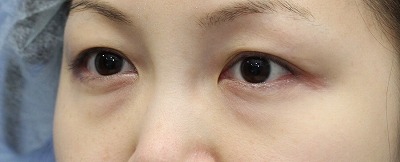 新宿ラクル美容外科クリニック　山本厚志　「切らない目の下のたるみ取り」　リデンシティⅡ　手術前