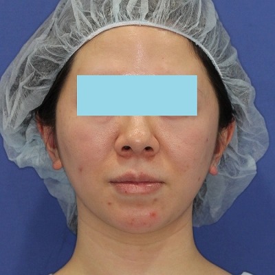 新宿ラクル美容外科クリニック　山本厚志　「ミントリフトⅡminiS flex（シークレットリフト）」手術前
