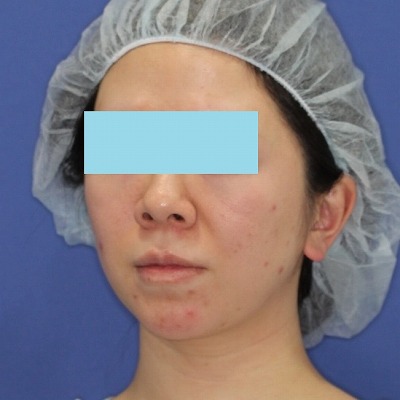 新宿ラクル美容外科クリニック　山本厚志　「ミントリフトⅡminiS flex（シークレットリフト）」手術前