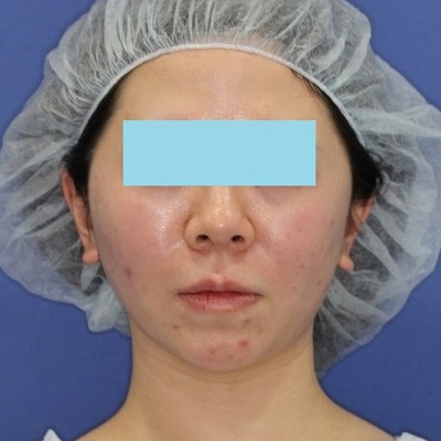新宿ラクル美容外科クリニック　山本厚志　「ミントリフトⅡminiS flex（シークレットリフト）」手術直後
