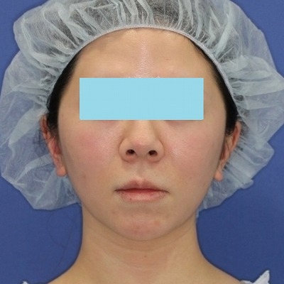 新宿ラクル美容外科クリニック　山本厚志　「ミントリフトⅡminiS flex（シークレットリフト）」手術後１ヶ月目