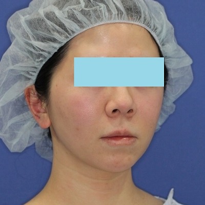 新宿ラクル美容外科クリニック　山本厚志　「ミントリフトⅡminiS flex（シークレットリフト）」手術後１ヶ月目