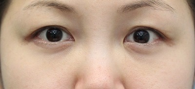 新宿ラクル美容外科クリニック　山本厚志　「切らない目の下のたるみ取り」　リデンシティⅡ　手術後２ヶ月目