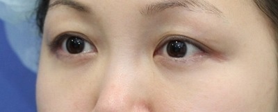 新宿ラクル美容外科クリニック　山本厚志　「切らない目の下のたるみ取り」　リデンシティⅡ　手術後２ヶ月目