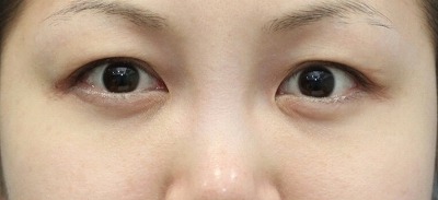 新宿ラクル美容外科クリニック　山本厚志　「切らない目の下のたるみ取り」　リデンシティⅡ　手術後１ヶ月目