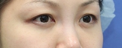 新宿ラクル美容外科クリニック　山本厚志　「切らない目の下のたるみ取り」　リデンシティⅡ　手術後１ヶ月目