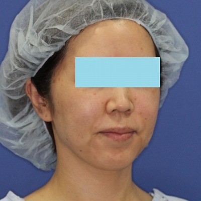 新宿ラクル美容外科クリニック　山本厚志　「ミントリフトⅡminiS flex（シークレットリフト）」　手術前