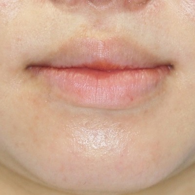 口元整形のビフォーアフター 代女性 口唇縮小術 上下口唇 手術後3ヶ月目の変化です 新宿ラクル美容外科クリニック 山本厚志のブログ