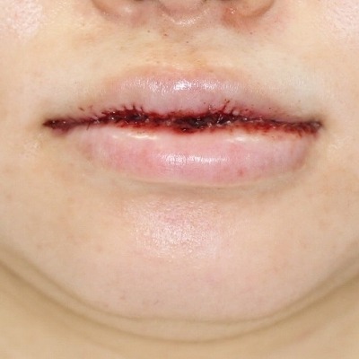 口元整形のビフォーアフター 代女性 口唇縮小術 上下口唇 手術後3ヶ月目の変化です 新宿ラクル美容外科クリニック 山本厚志のブログ