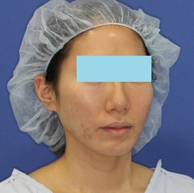 新宿ラクル美容外科クリニック　山本厚志　「ミントリフトⅡminiS flex（シークレットリフト）」　手術前