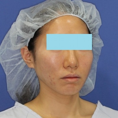 新宿ラクル美容外科クリニック　山本厚志　「ミントリフトⅡminiS flex（シークレットリフト）」　手術直後