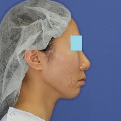 新宿ラクル美容外科クリニック　山本厚志　「ミントリフトⅡminiS flex（シークレットリフト）」　手術直後