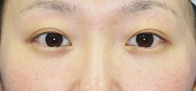 涙袋形成のビフォーアフター 代女性 手術直後の変化です 新宿ラクル美容外科クリニック 山本厚志のブログ