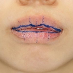 新宿ラクル美容外科クリニック　山本厚志　「口唇縮小術」　手術前　デザイン