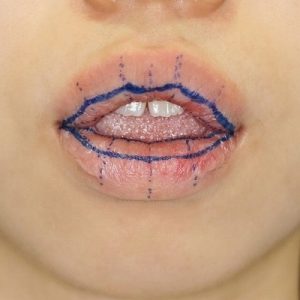 新宿ラクル美容外科クリニック　山本厚志　「口唇縮小術」　手術前　デザイン