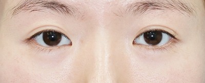 目元整形のビフォーアフター 40代女性 切らない目の下のたるみ取り ヒアルロン酸 Tear Trough 手術後6ヶ月目の変化をご紹介します 新宿ラクル美容外科クリニック 山本厚志のブログ