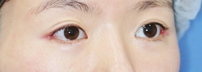 新宿ラクル美容外科クリニック　山本厚志　目尻切開＋下眼瞼下制術　手術後１週間目