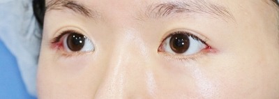 新宿ラクル美容外科クリニック　山本厚志　目尻切開＋下眼瞼下制術　手術後１週間目