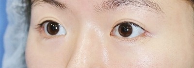 新宿ラクル美容外科クリニック　山本厚志　目尻切開＋下眼瞼下制術　手術後１ヶ月目