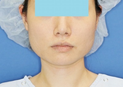 新宿ラクル美容外科クリニック　ボトックス（ゼオミン）（エラボトックス）　２０代女性　治療前