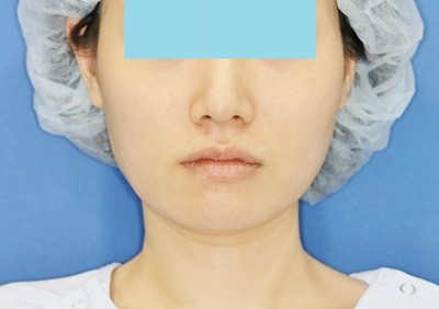 新宿ラクル美容外科クリニック　ボトックス（ゼオミン）（エラボトックス）　２０代女性　治療後２ヶ月目