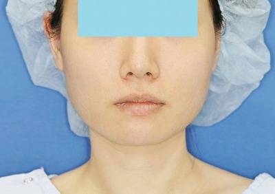 新宿ラクル美容外科クリニック　ボトックス（ゼオミン）（エラボトックス）　２０代女性　治療後１ヶ月目