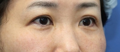 目元整形のビフォーアフター 40代女性 切らない目の下のたるみ取り ヒアルロン酸 Tear Trough 手術後6ヶ月目の変化をご紹介します 新宿ラクル美容外科クリニック 山本厚志のブログ