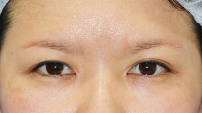 目元整形のビフォーアフター 40代女性 眉下切開法 手術後2ヶ月目の変化をご紹介します 新宿ラクル美容外科クリニック 山本厚志のブログ