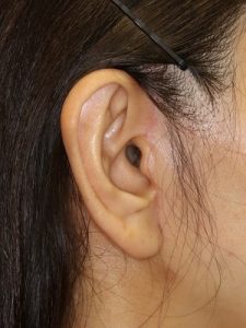 新宿ラクル美容外科クリニック　山本厚志　ナチュラルフェイスリフト　耳の傷痕　手術後２ヶ月目　６月２８日