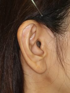 新宿ラクル美容外科クリニック　山本厚志　ナチュラルフェイスリフト　耳の傷痕　手術前　３月１７日