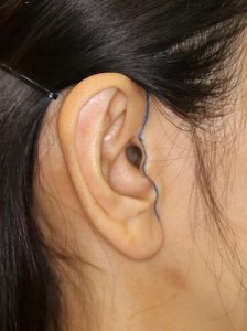 新宿ラクル美容外科クリニック　山本厚志　ナチュラルフェイスリフト　耳の傷痕　　デザイン　　６月２８日