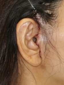 新宿ラクル美容外科クリニック　山本厚志　ナチュラルフェイスリフト　耳の傷痕　手術直後　６月２８日
